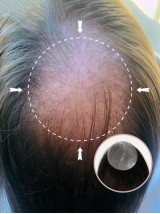 3 "* 3" Full Skin Base Menselijk Haar Cover Up Haar Patches Geen Chirurgische Oplossing Voor Alopecia Areata