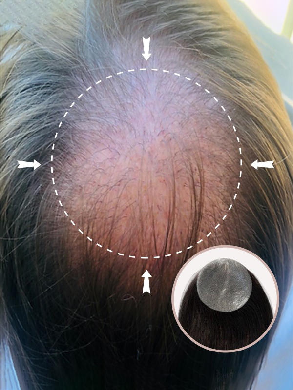 3 "* 3" Full Skin Base Menselijk Haar Cover Up Haar Patches Geen Chirurgische Oplossing Voor Alopecia Areata