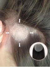 2 "* 2" Full Skin Base Human Hair Cover Up Hair Patches Geen Chirurgische Oplossing Voor Alopecia Areata
