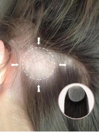 2 "* 2" Full Skin Base Human Hair Cover Up Hair Patches Geen Chirurgische Oplossing Voor Alopecia Areata
