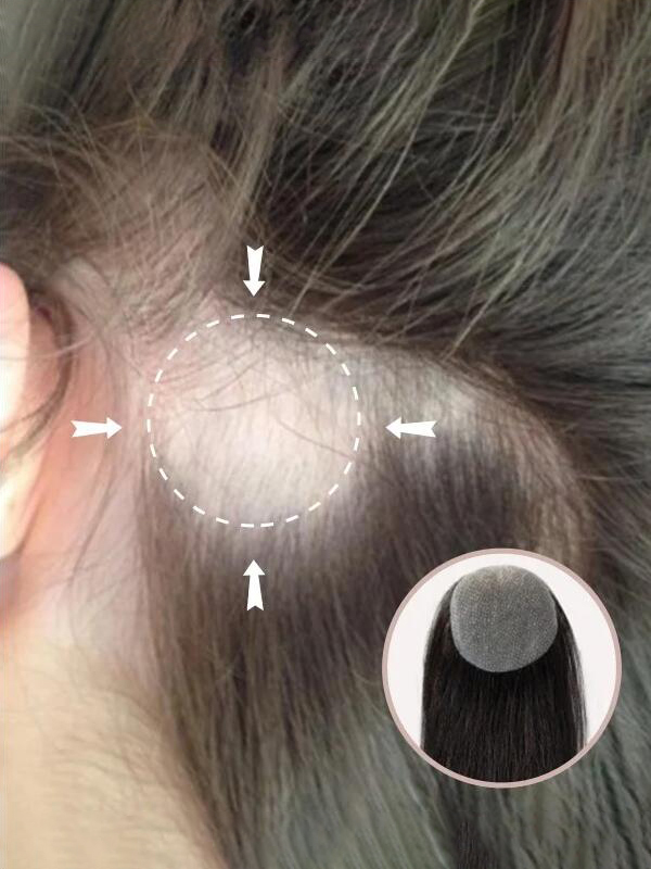 2 "* 2" Full Skin Base Human Hair Cover Up Hair Patches Geen Chirurgische Oplossing Voor Alopecia Areata